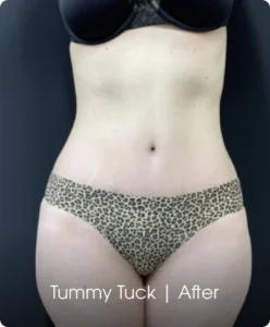 Tummy Tuck: After Banner
