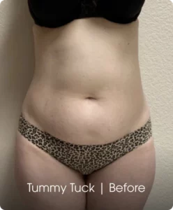 Tummy Tuck: Before Banner