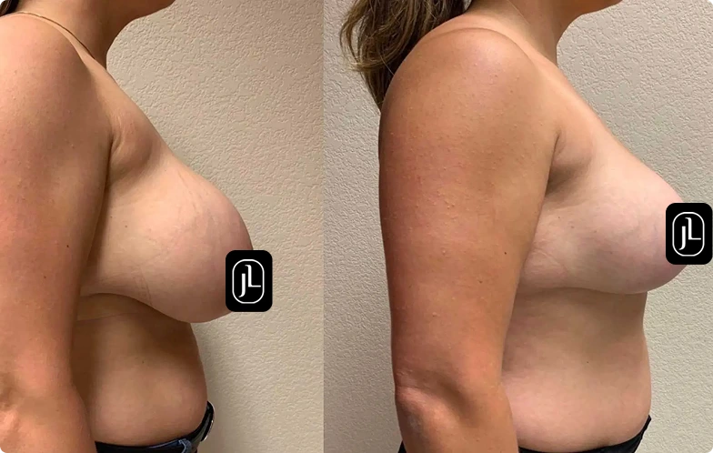 Before and After Gallery: Breast Fat Transfer