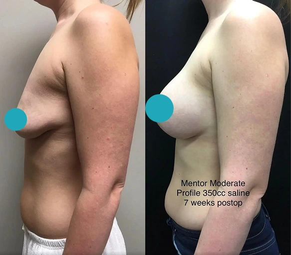 Breast Augmentation With Lift