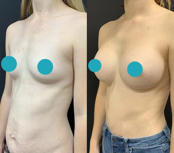 Breast Augmentation
