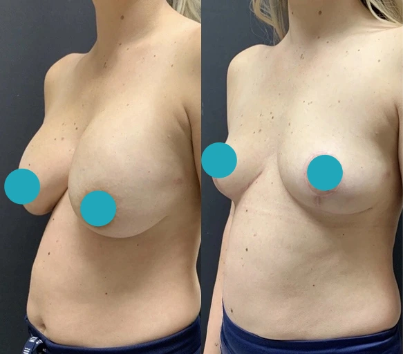 Breast Implant Removal