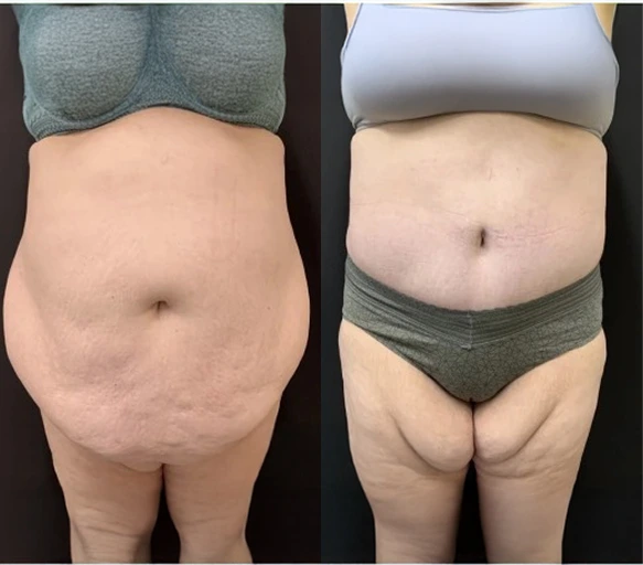 Circumferential Tummy Tuck