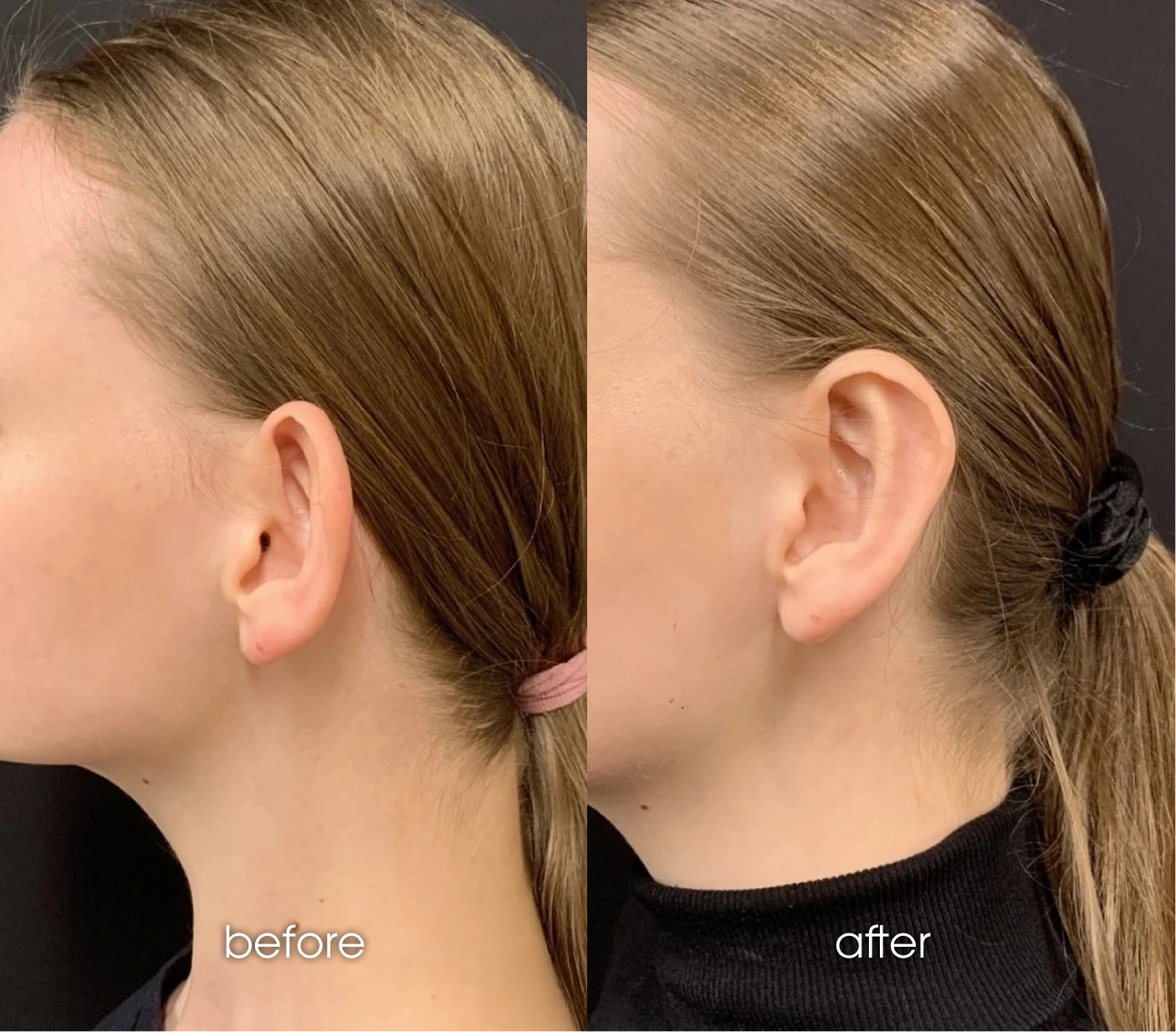 Ear Shaping Otoplasty