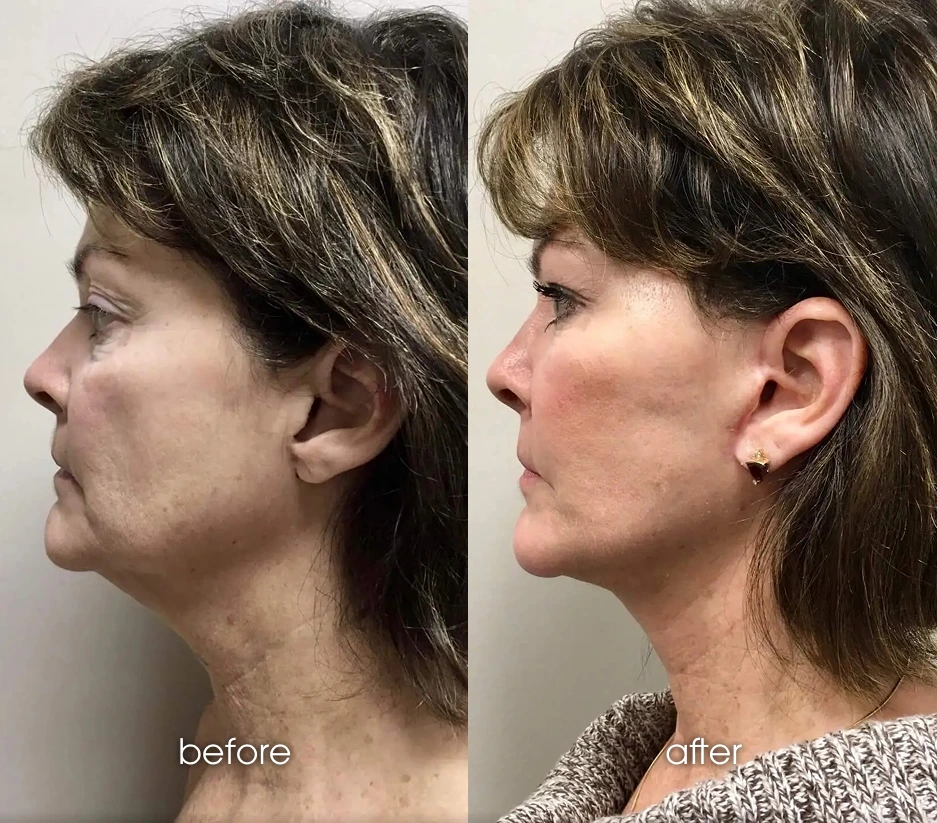 Neck Lift