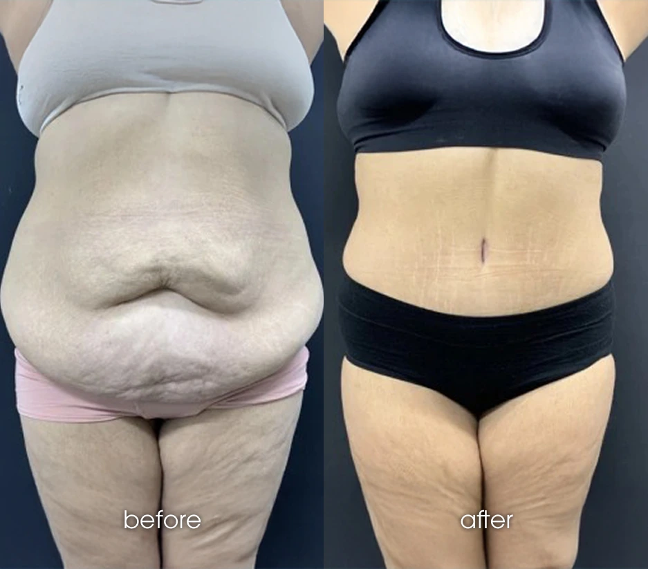 Rectus Diastasis Repair