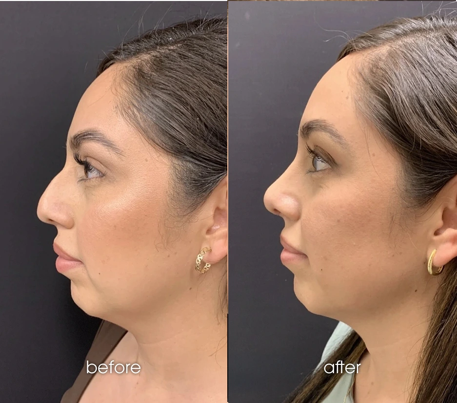 Rhinoplasty