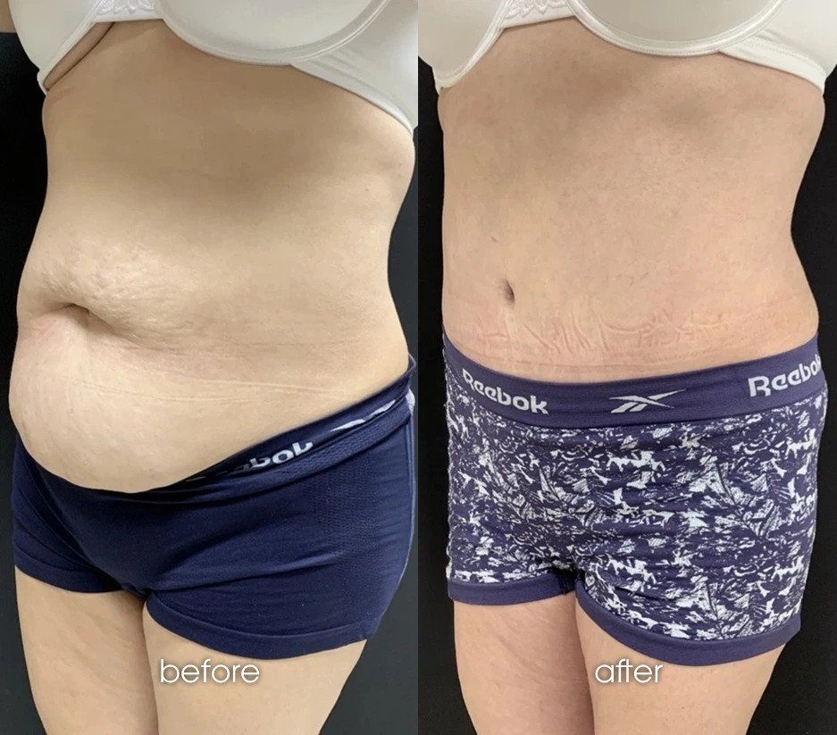 Tummy Tuck