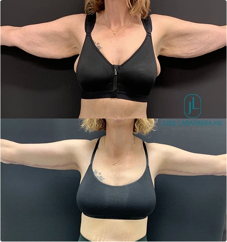 Before and After Gallery: Arm Lift