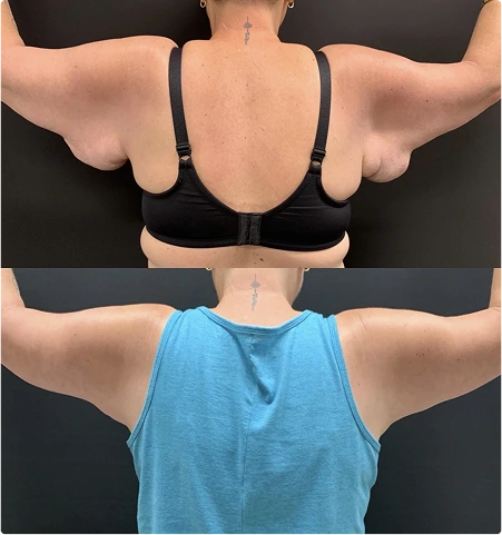 Before and After Gallery: Arm Lift