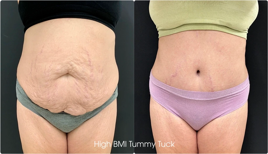 Regular Tummy Tuck Gallery: Before and After