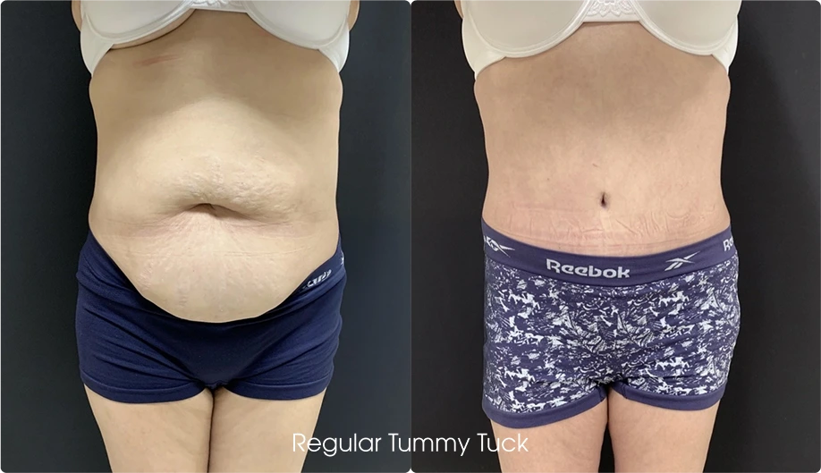 Regular Tummy Tuck Gallery: Before and After