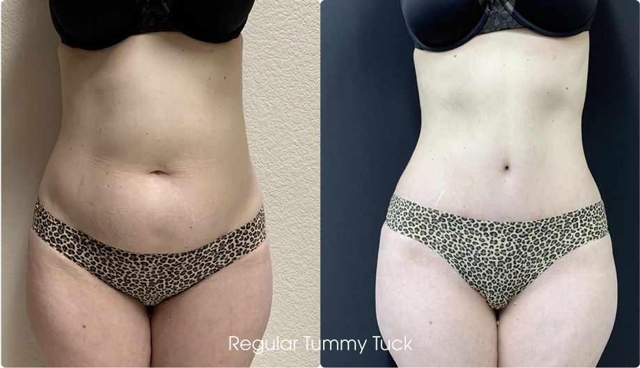 Tummy Tuck Gallery: Before and After