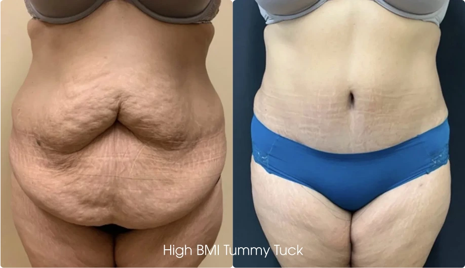 Tummy Tuck Gallery: Before and After