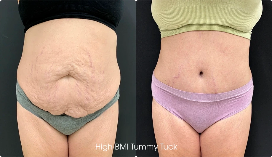 Tummy Tuck Gallery: Before and After