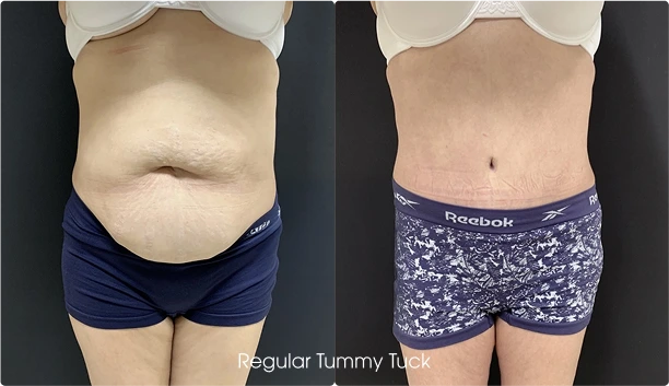 Tummy Tuck Gallery: Before and After