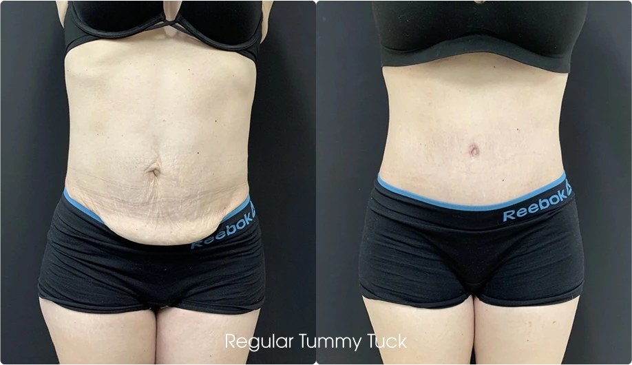 Tummy Tuck Gallery: Before and After