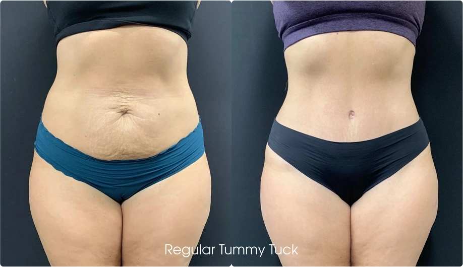Tummy Tuck Gallery: Before and After