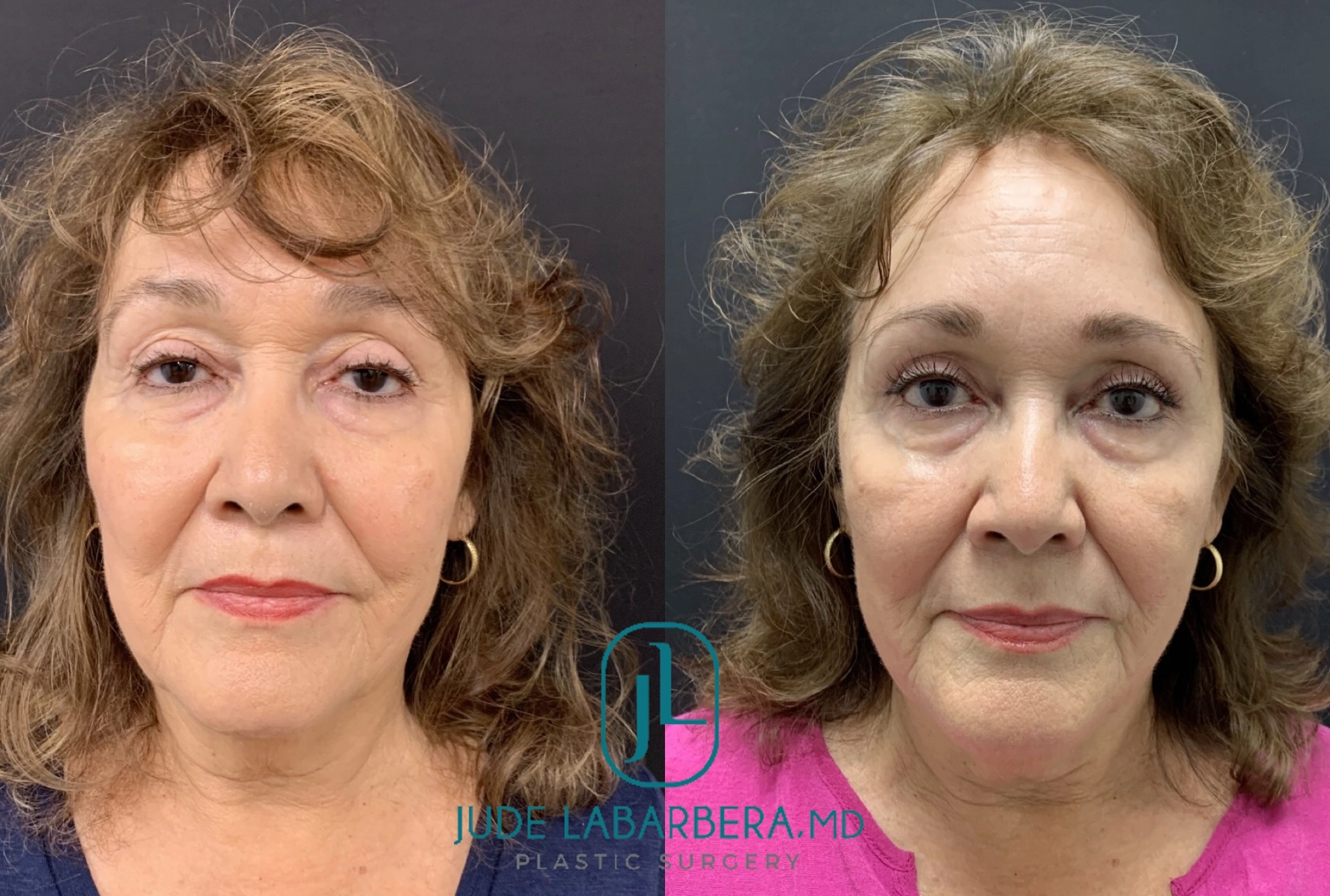 Before and After Gallery: Facelift Banner