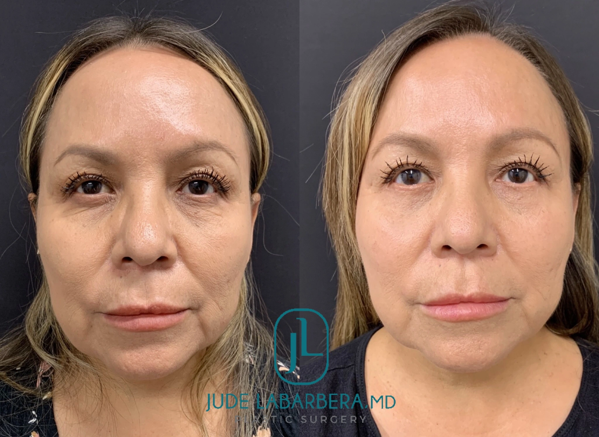 Before and After Gallery: Facelift Banner