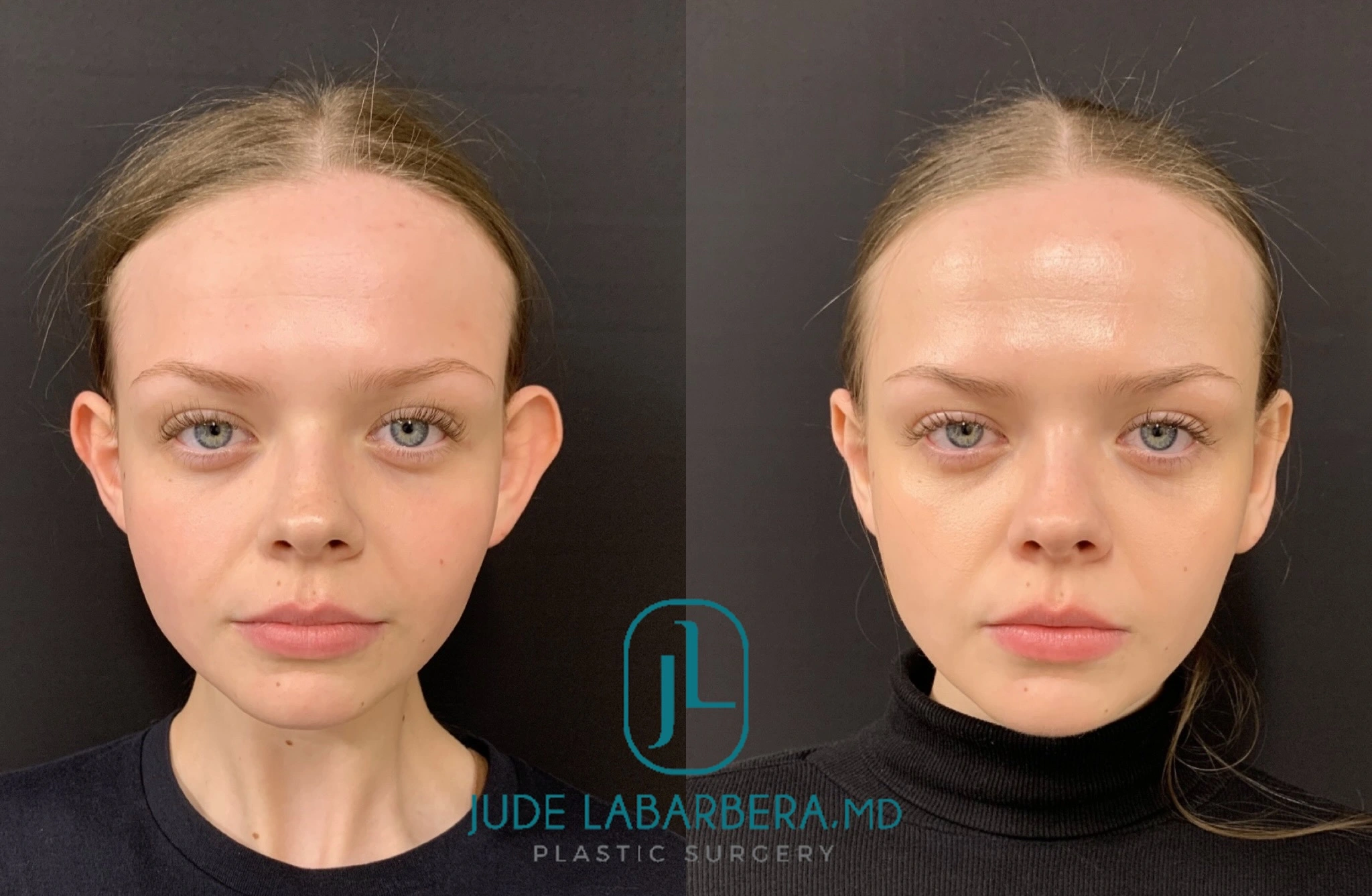 Before and After Gallery: Facelift Banner