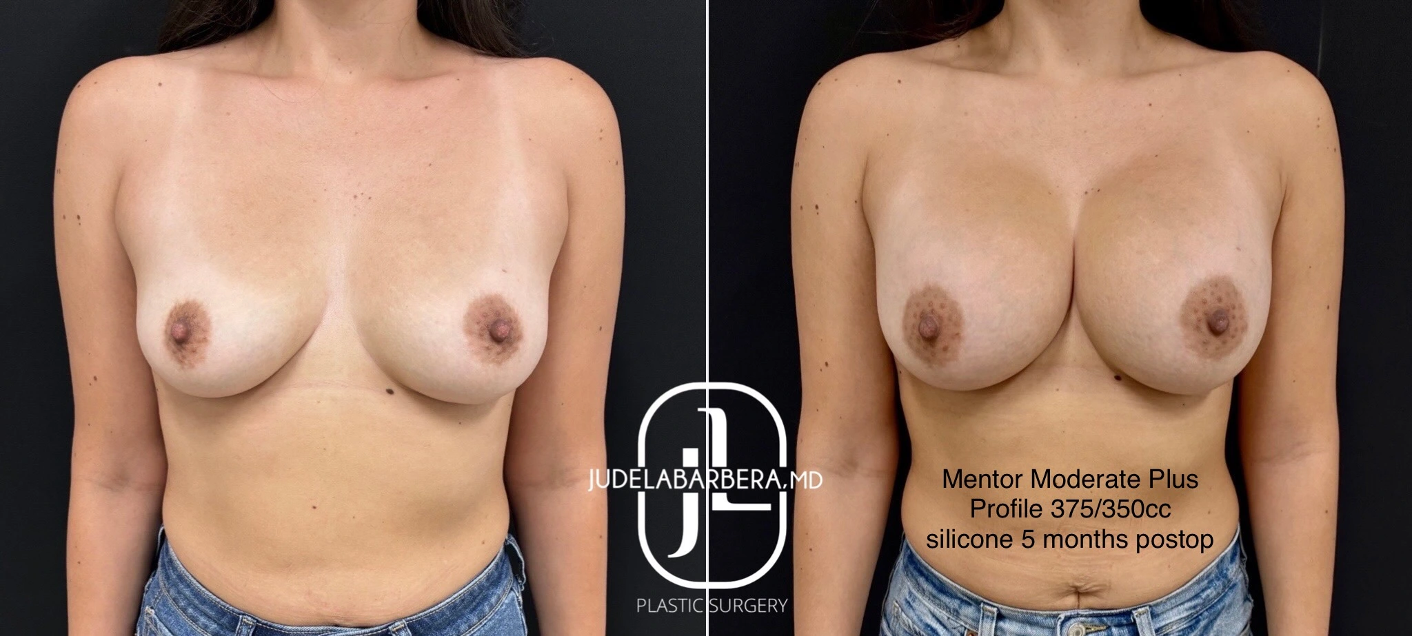 Before and After Gallery: Breast Augmentation Banner