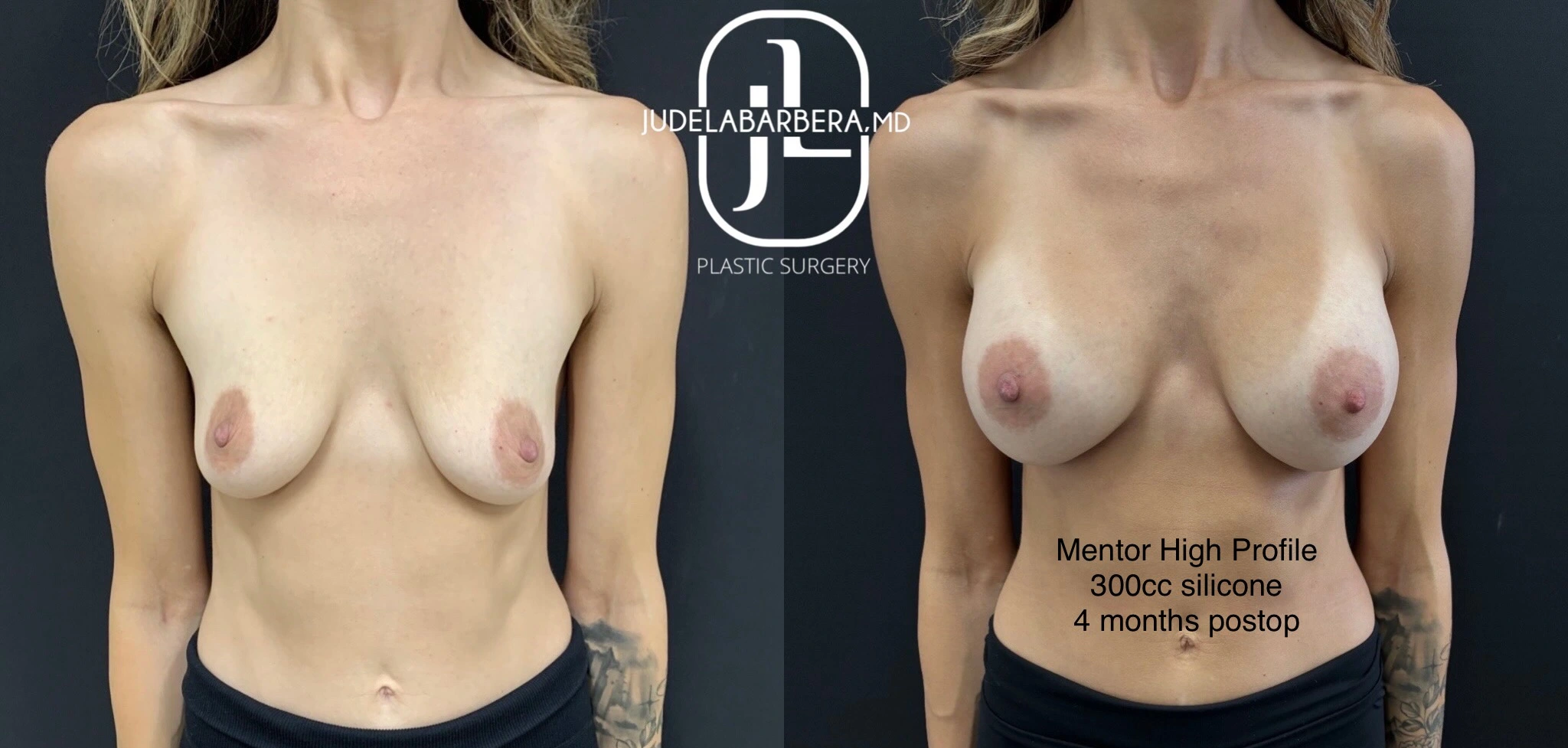 Before and After Gallery: Breast Augmentation Banner