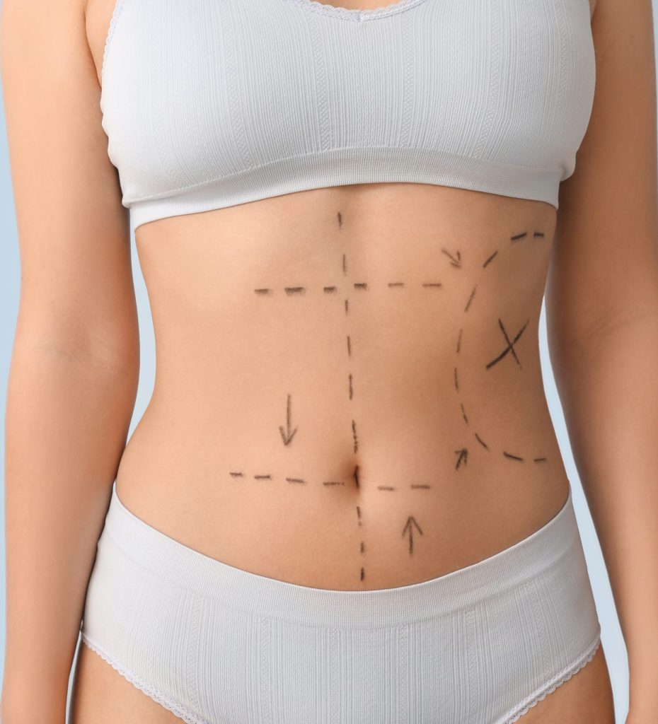 Am I a Good Candidate for Lipo 360? Body Fat, Skin Elasticity, and Goals banner