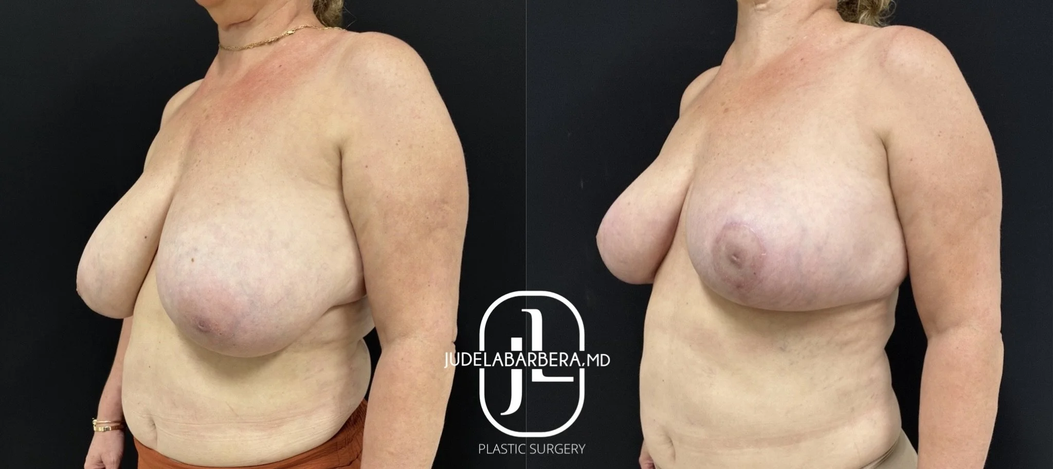 Before and after breast lift surgery results shown from side view