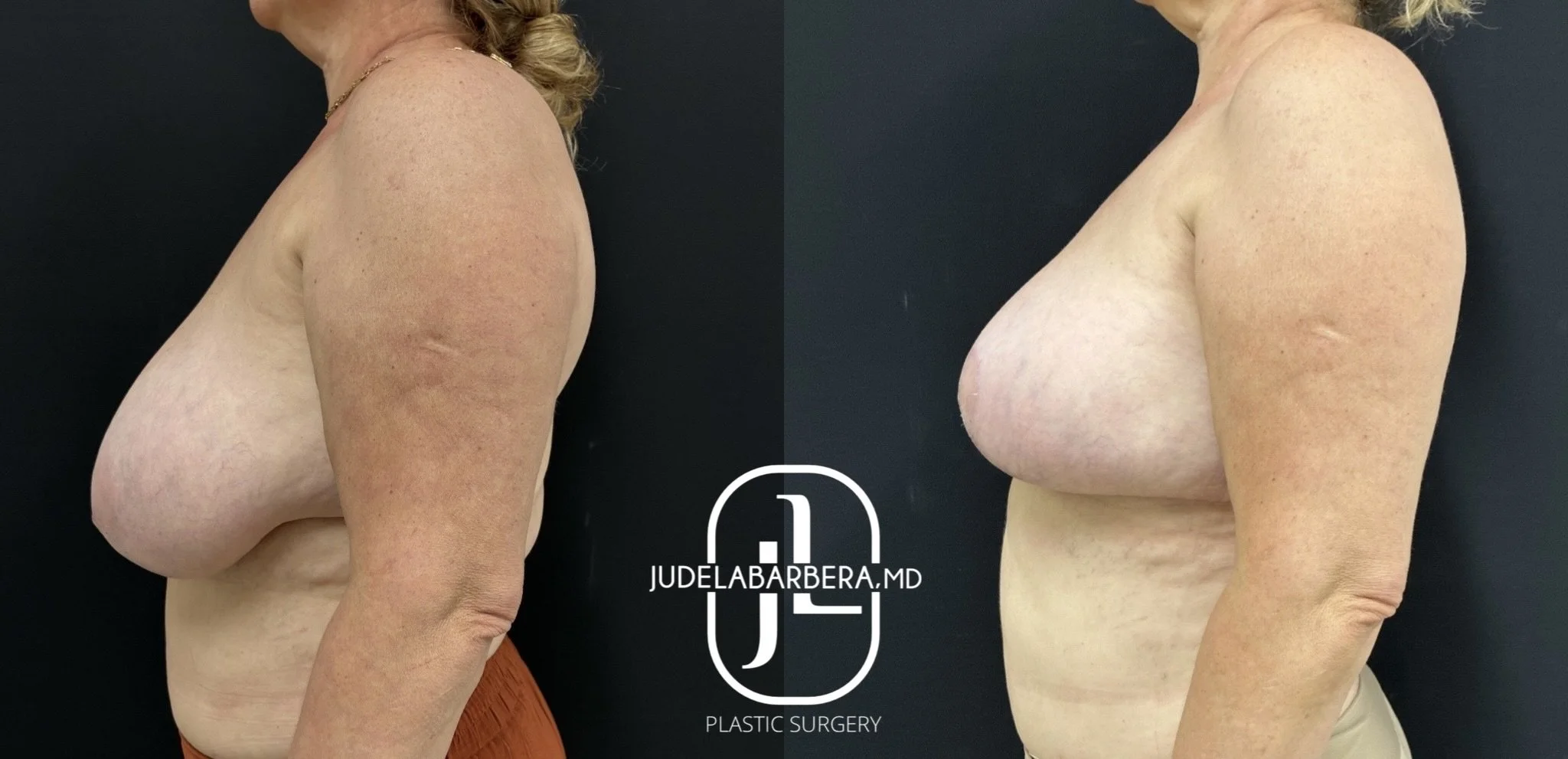 Side-by-side before and after breast surgery comparison showing patient profile view