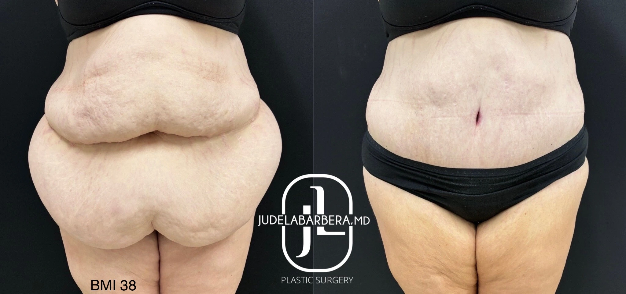 Before and after abdominoplasty: rear view showing reduced abdominal fullness and improved contour, BMI 38 noted on left side