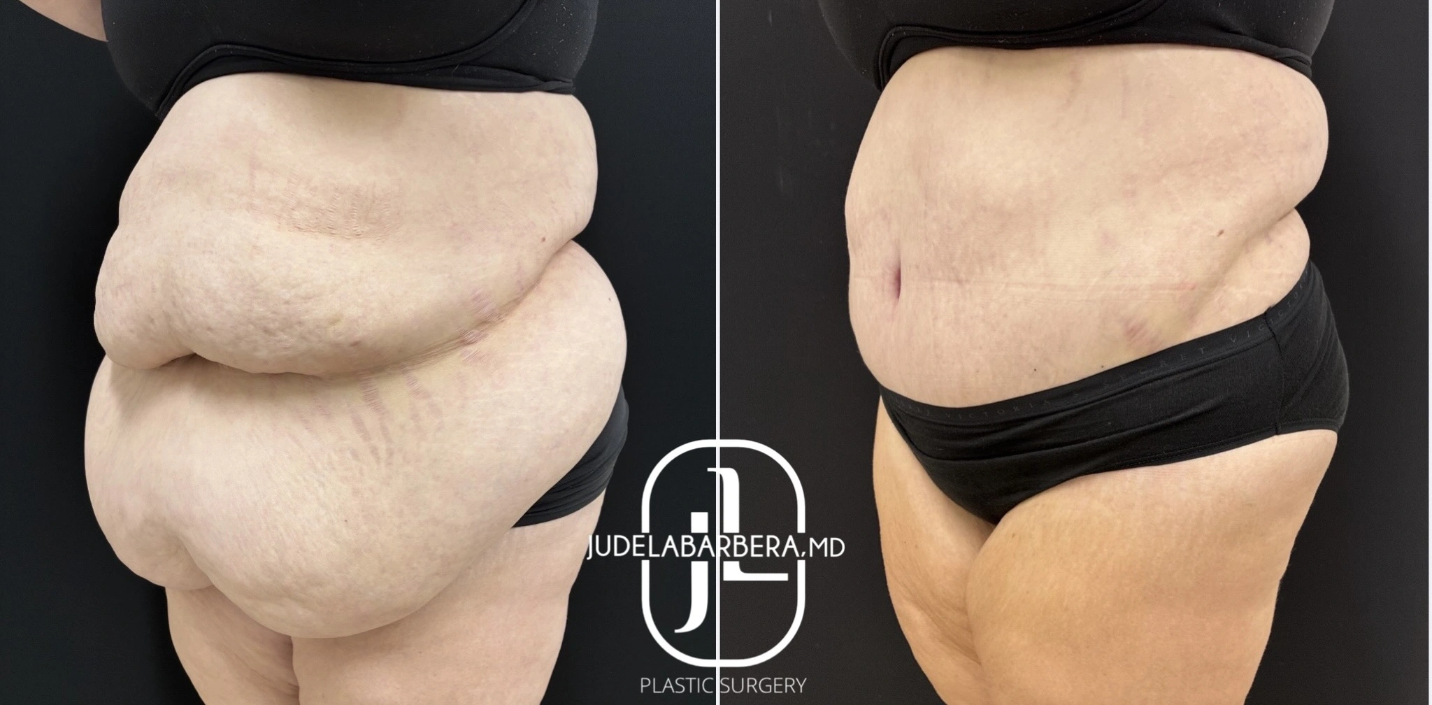 Before and after abdominoplasty: side view showing decreased abdominal projection and flatter profile