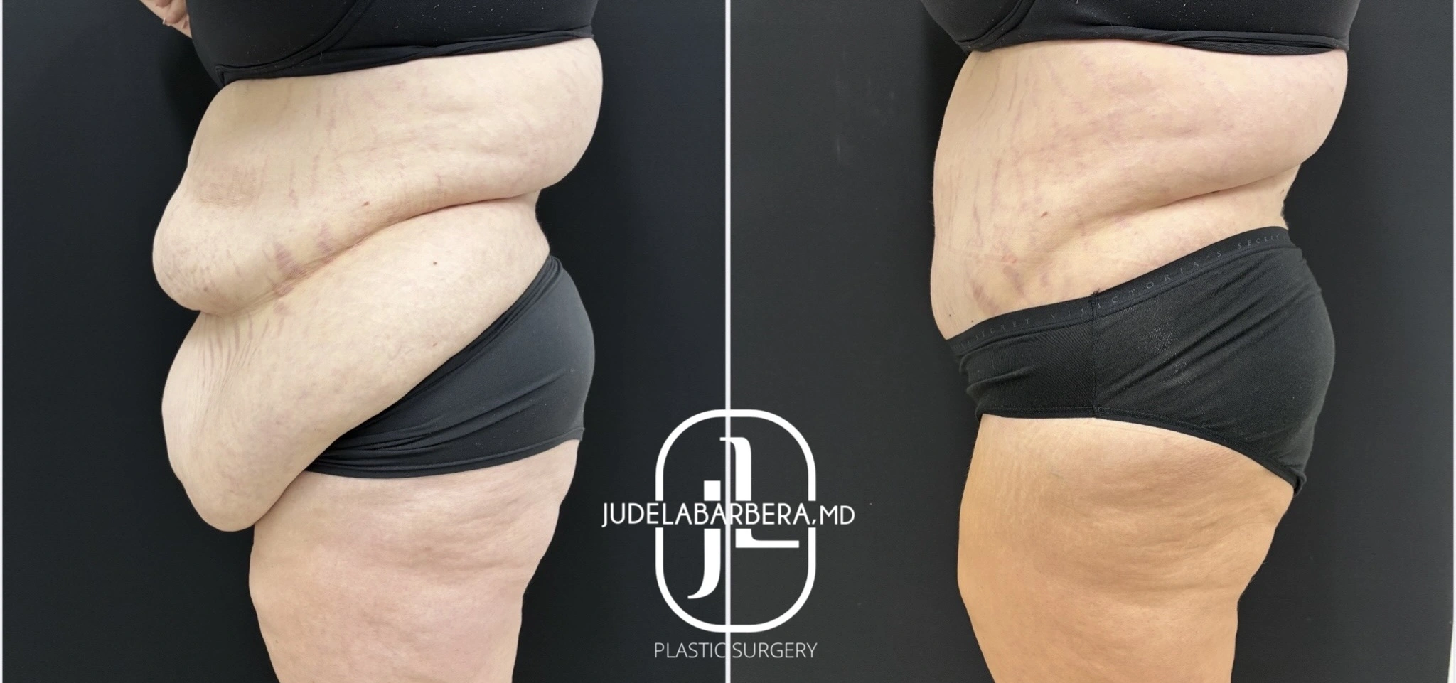 Before and after abdominoplasty comparison showing side profile view