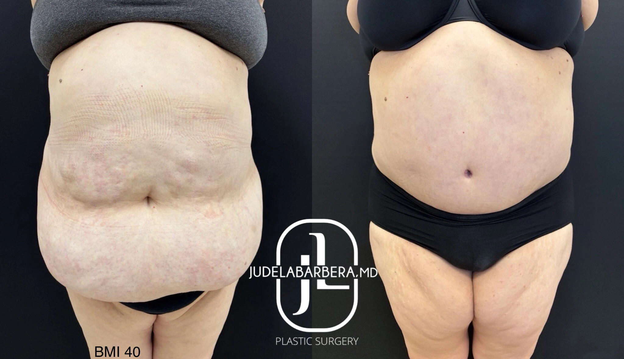 Before and after abdominoplasty comparison showing front view, BMI 40 marked on left side