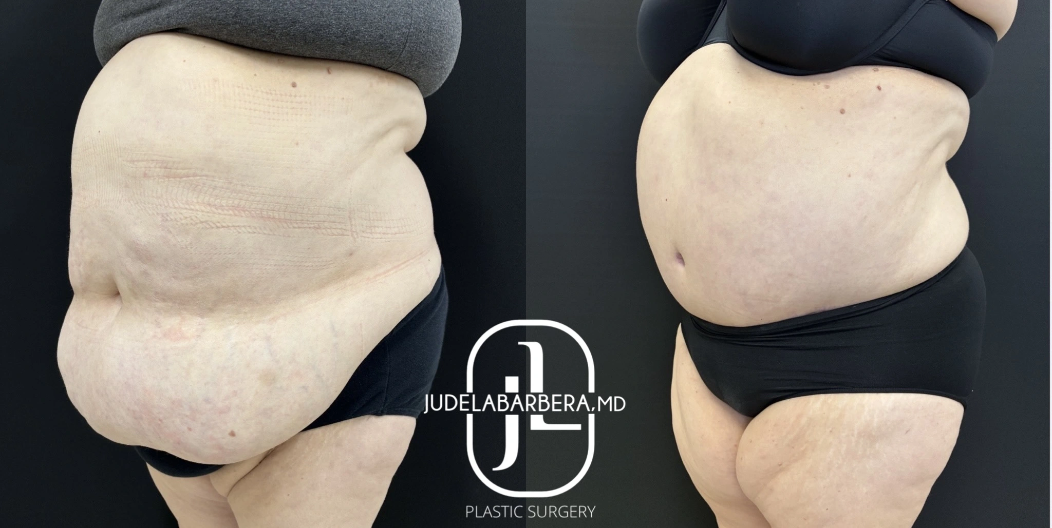 Before and after abdominoplasty comparison showing side profile view