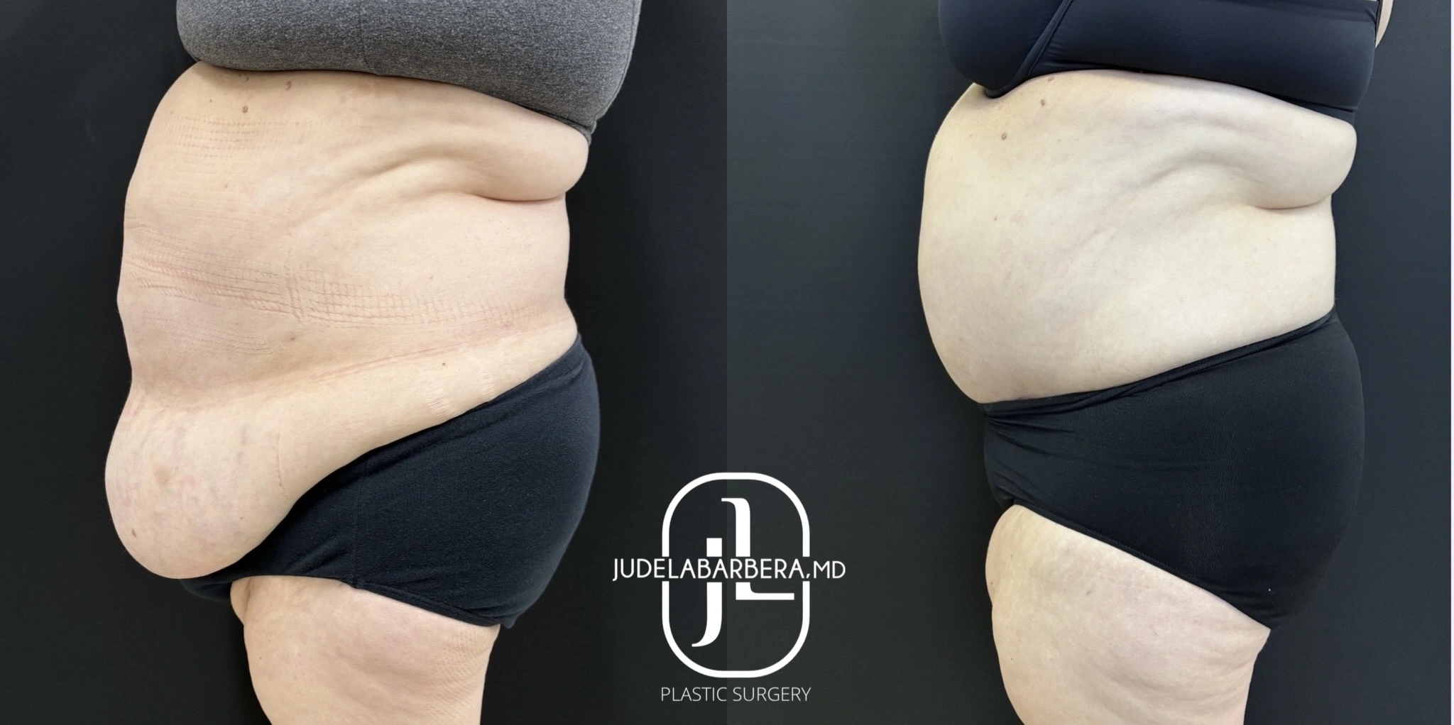 Before and after abdominoplasty comparison showing side profile view