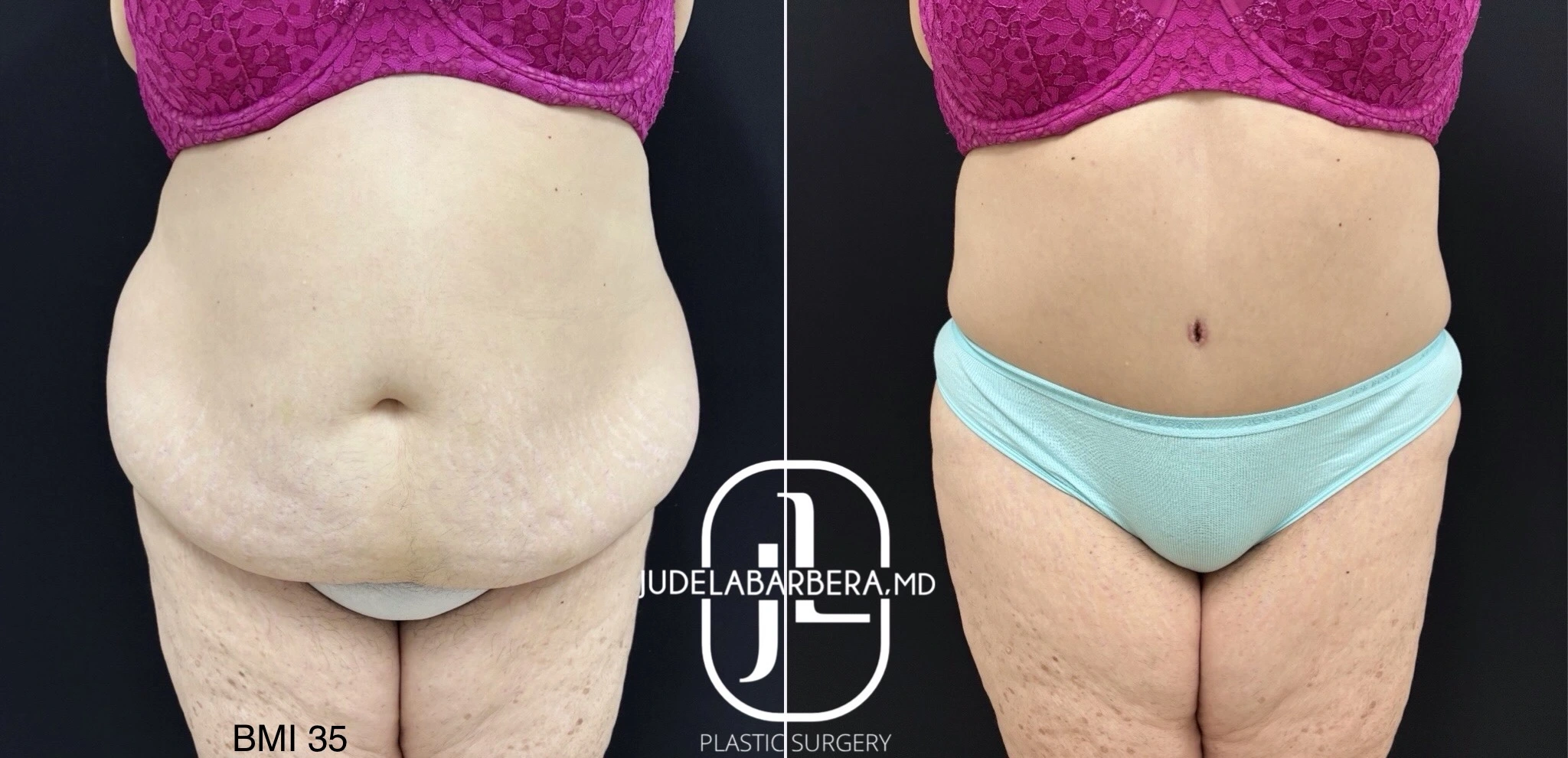 Before and after body contouring, front view showing reduced abdominal projection, marked BMI 35 pre-procedure