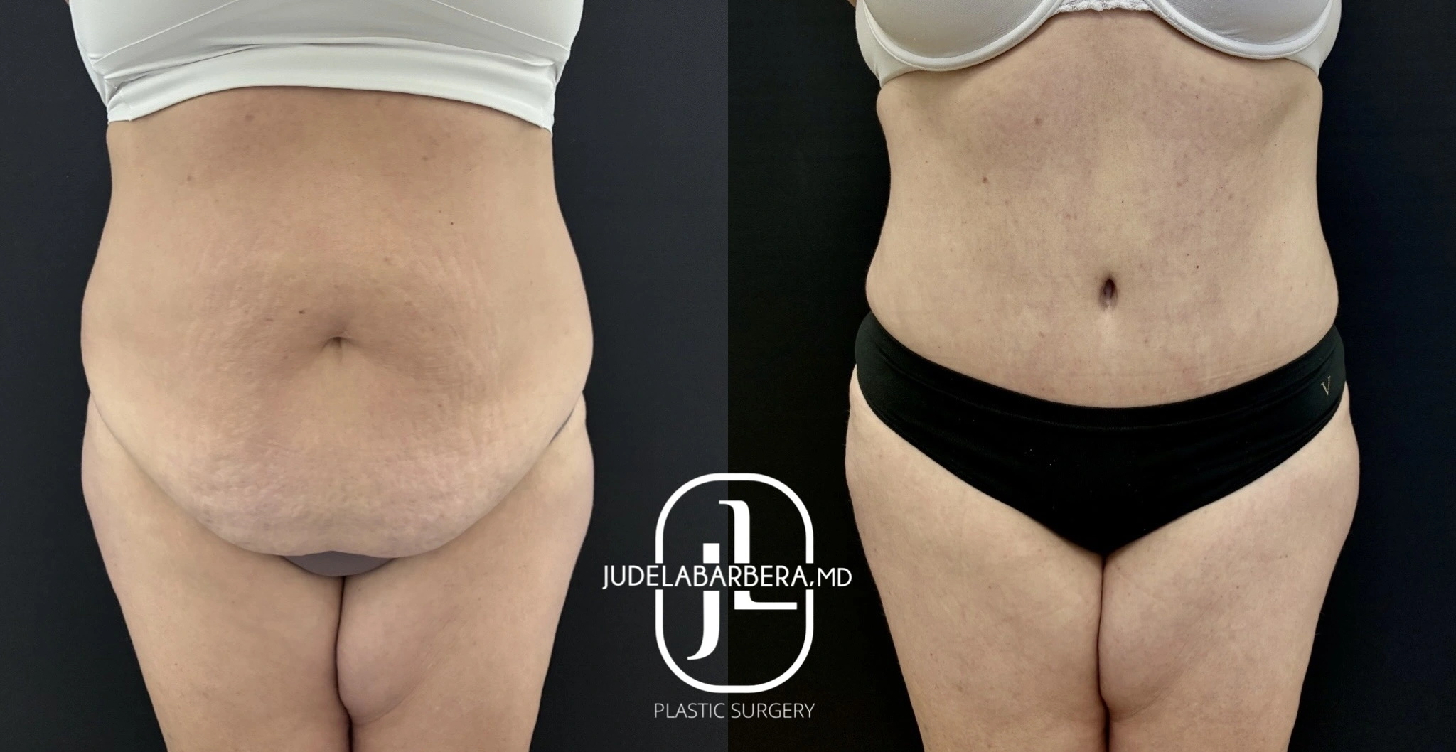 Before and after abdominoplasty: front view demonstrating improved abdominal contour and reduced loose skin
