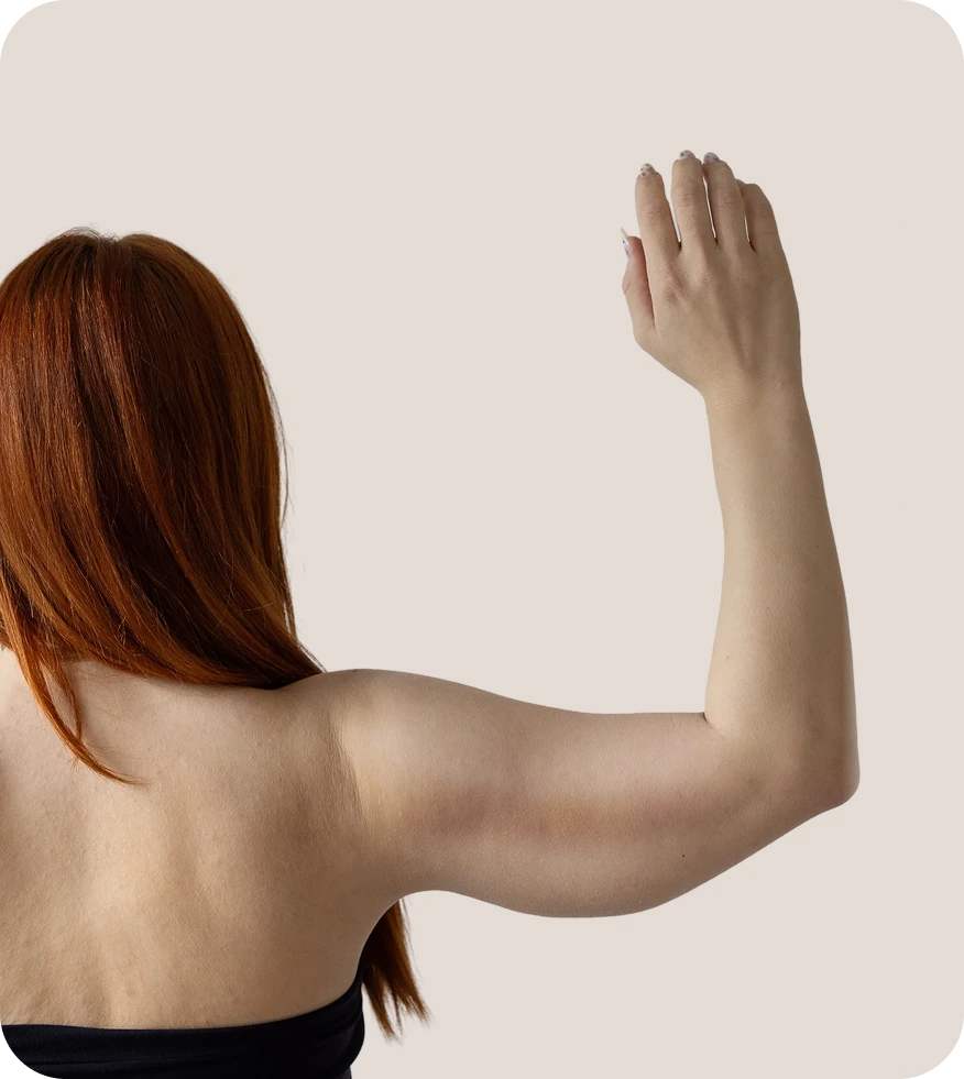 Woman flexing arm to show loose skin on upper arm, demonstrating arm lift candidacy