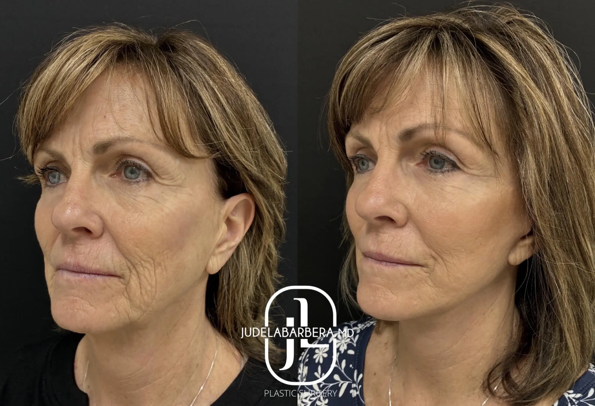 Facelift Case 12: before and after side profile views showing refined facial contours and improved skin texture
