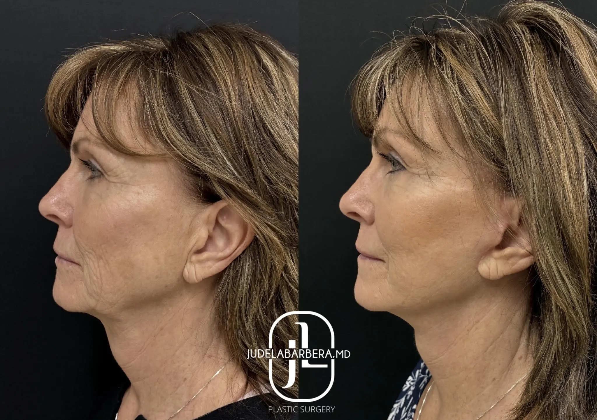 Facelift Case 12: before and after profile views showing improved skin tightness and facial contour