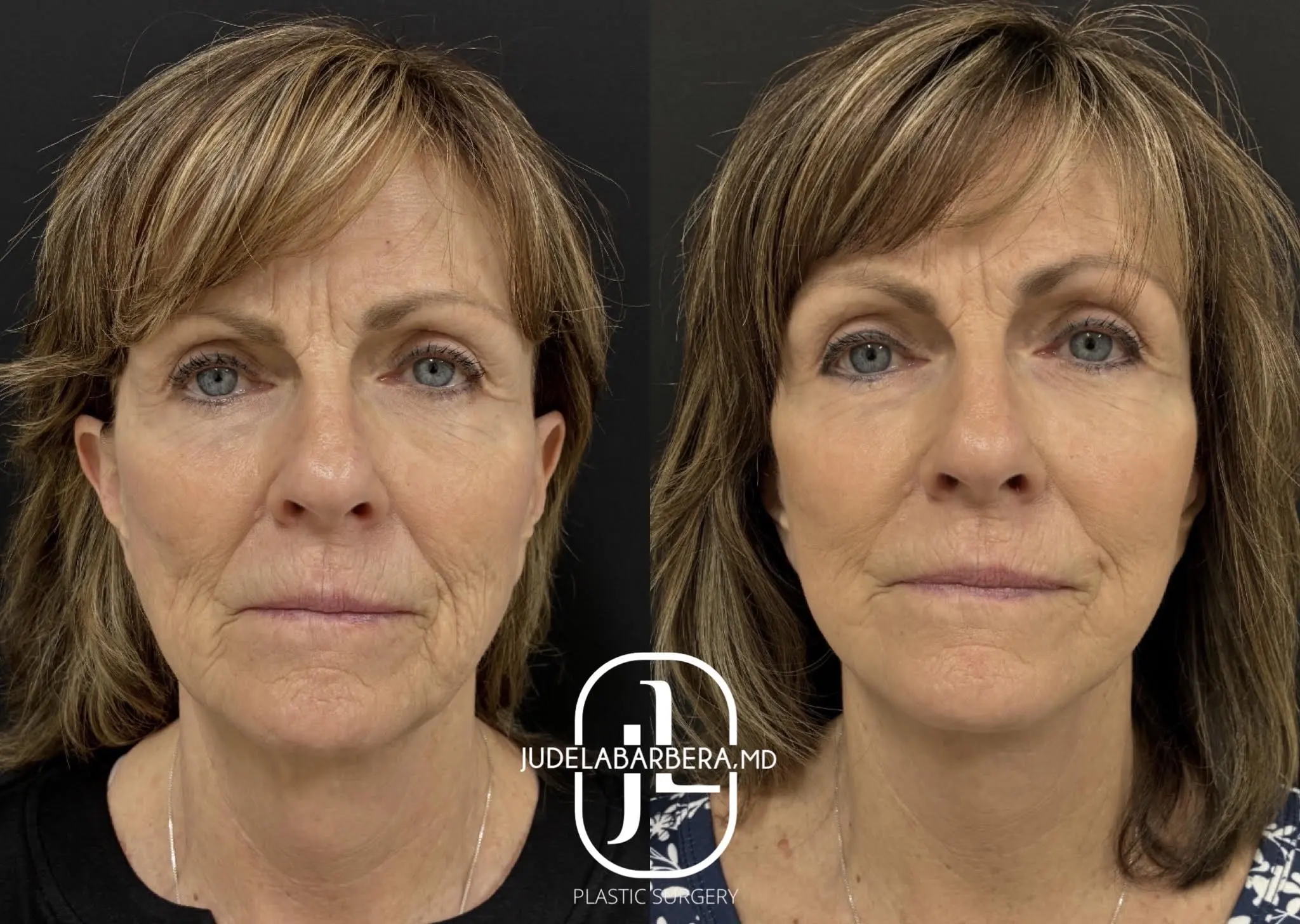 Before and after facelift results showing improved facial contours and reduced sagging
