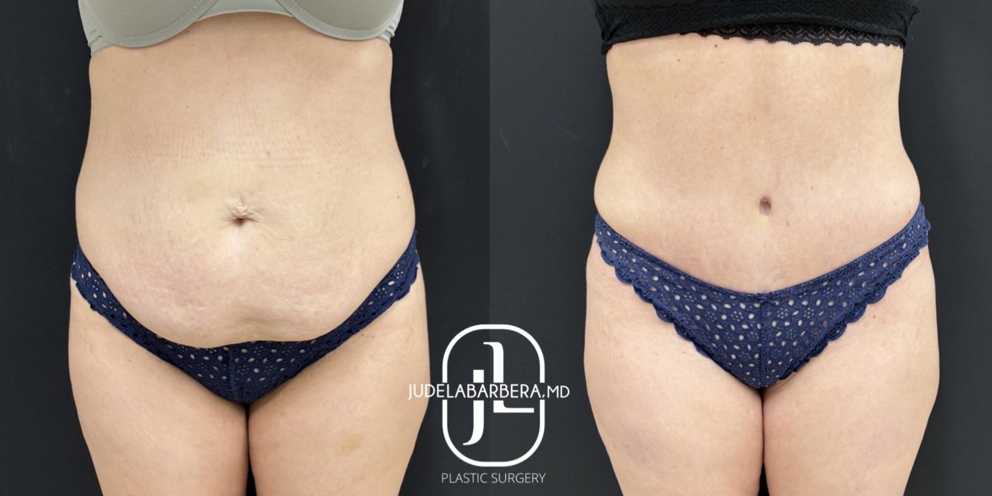 Before and after abdominoplasty results showing improved abdominal contour and skin tightness