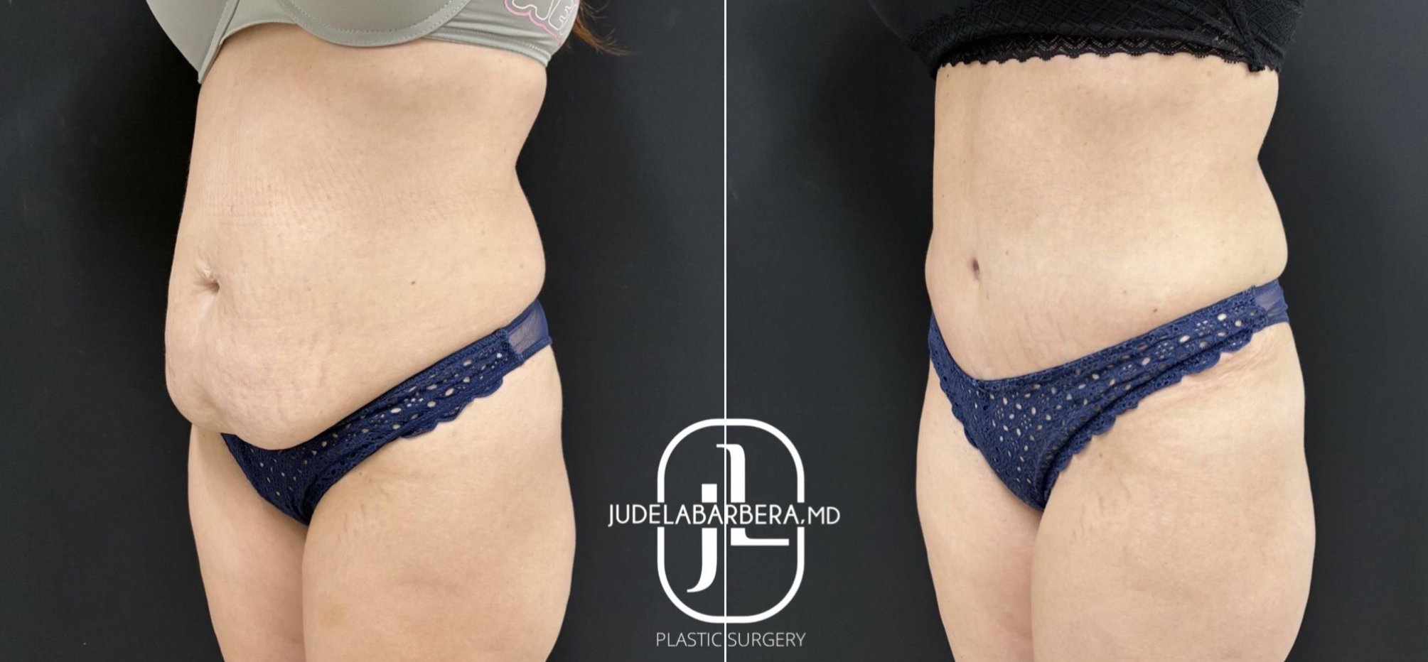 Before and after abdominoplasty results showing reduced abdominal contour and improved waistline definition