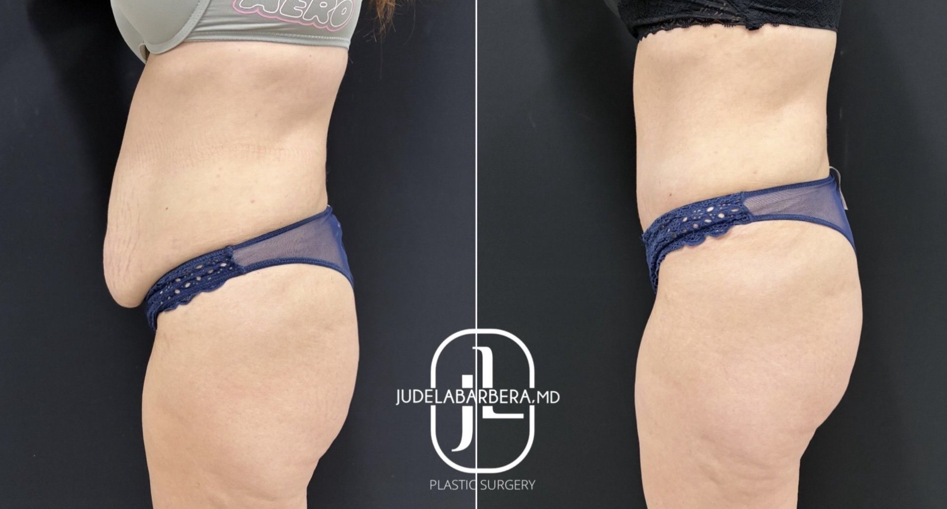 Before and after side-by-side view of abdominoplasty results showing improved abdominal contour
