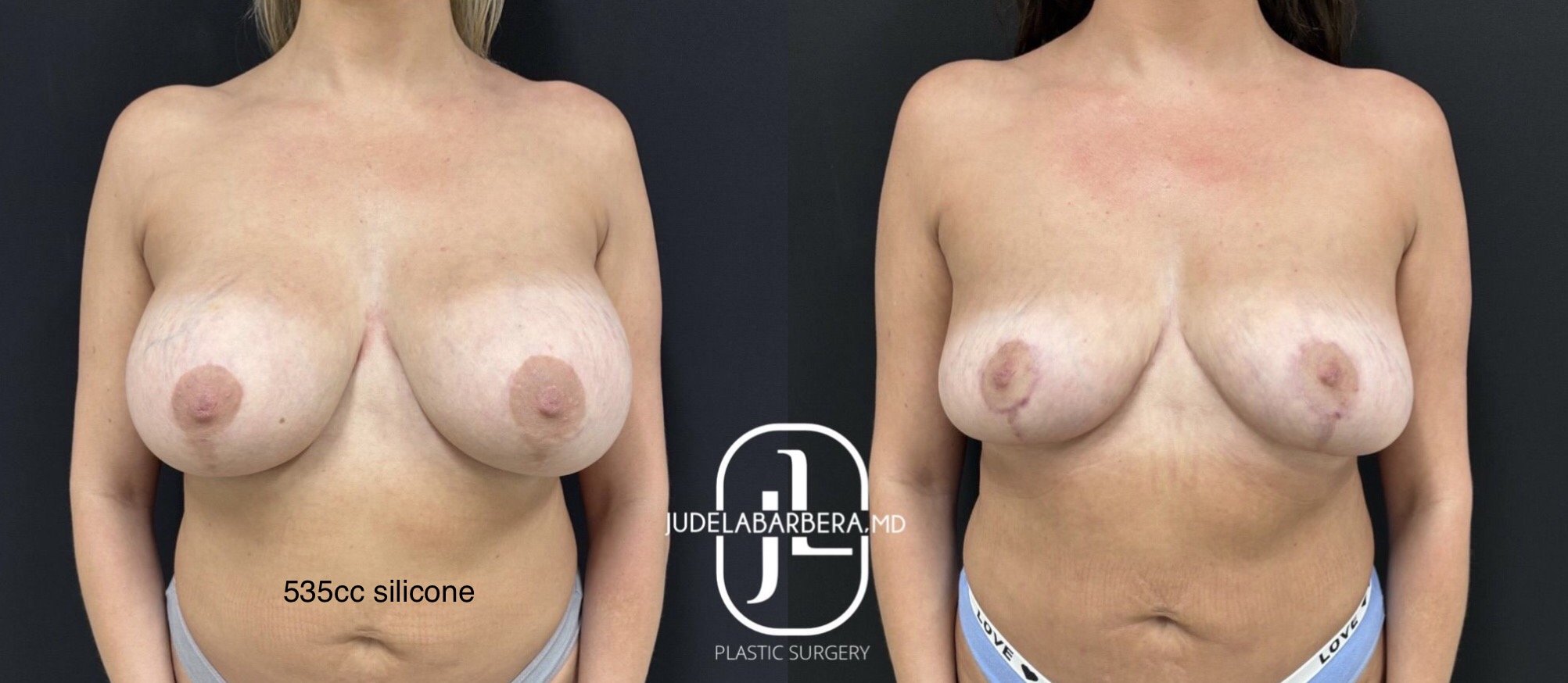 Breast implant revision before and after: left side shows 535cc silicone implants, right side shows results after revision by Dr. LaBarbera