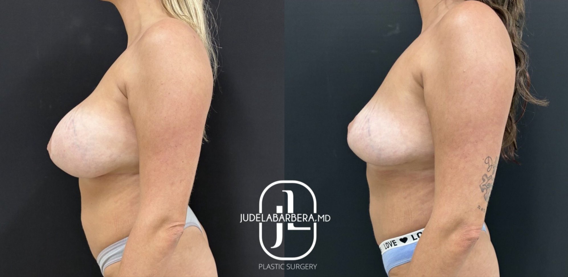 Breast augmentation before and after results, side profile comparison