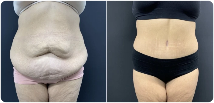 Before & After Tummy Tuck Banner