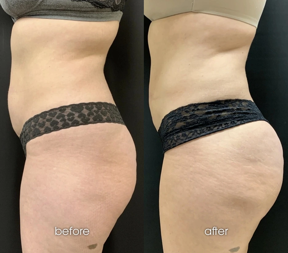 Brazilian Butt Lift Banner