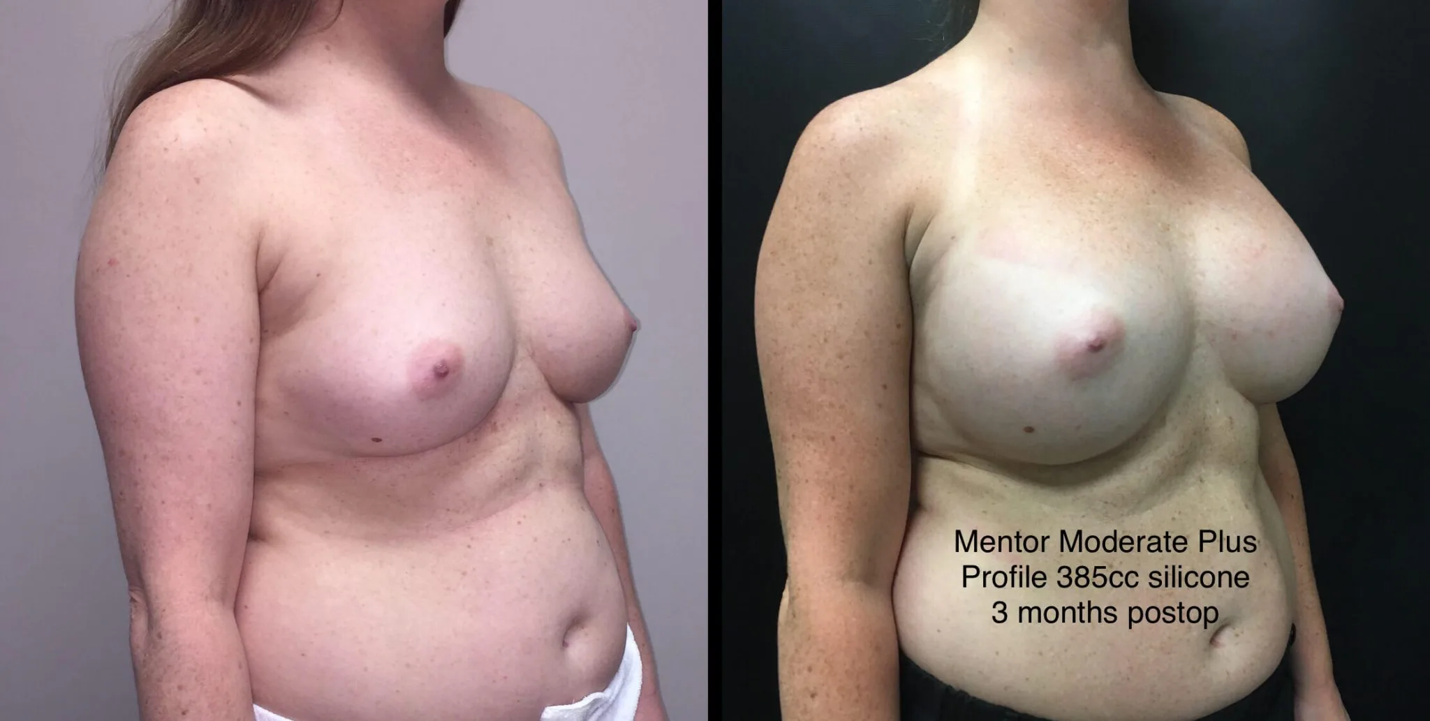 BREAST AUGMENTATION Before & After Case Number 00021